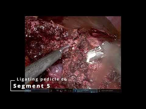 Robotic Radical Cholecystectomy