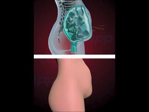 AMAZING TRIPLETS FIGHTING INSIDE THE WOMB  (3D ANIMATION)