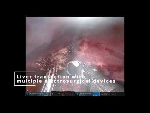 Robotic Radical Cholecystectomy