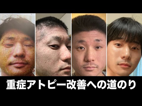 寝たきりになるほどの超重症アトピーを改善した道のり