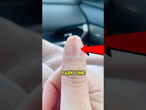 RUN To The Hospital If You See This On Your Nail 😨 #viral