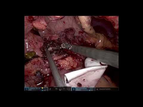 Robotic Puestow Procedure