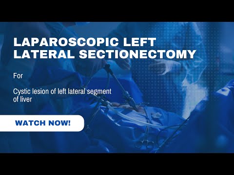 Laparoscopic left lateral sectionectomy of liver