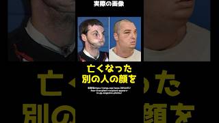 【仰天】銃の暴発で顎と鼻を失った男性→別の人の顔を全面移植した結果…！#shorts