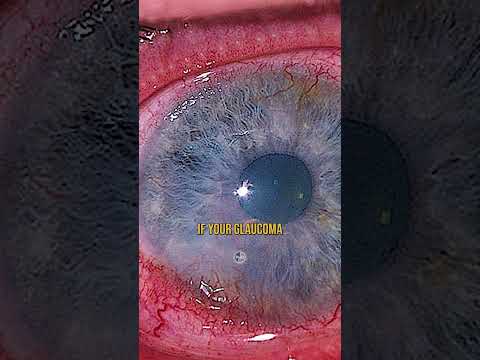 Glaucoma and the Carnivore Diet 👉