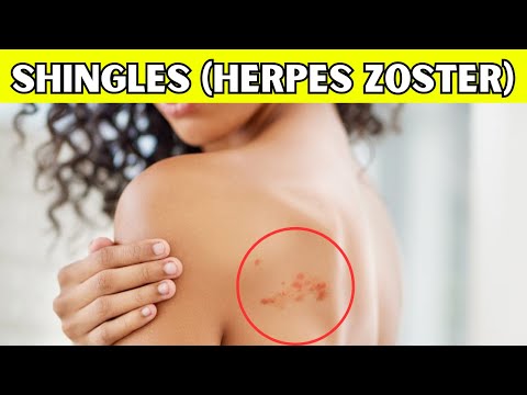 Shingles (Herpes Zoster Infection) - Causes, Signs And Symptoms, Diagnosis, And Treatment