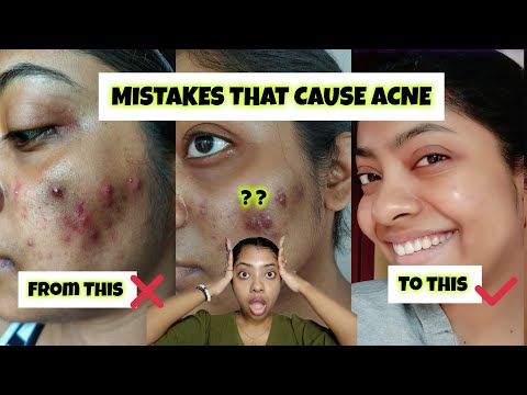 Common mistakes that cause Acne