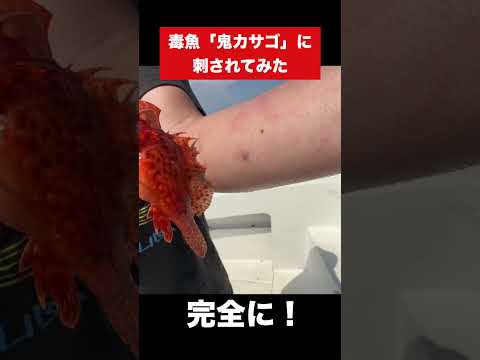 毒魚「オニカサゴ」に刺されてしまった…