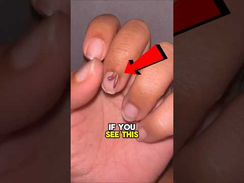 RUN To A Doctor If You See This On Your Nail 😨 #viral