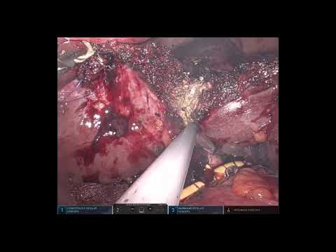 Robotic Left Hepatectomy