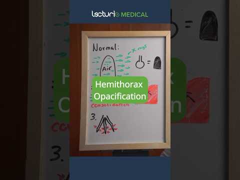 Hemithorax Opacification on X-ray: Key Facts 🩺 #ChestXray #Radiology #USMLE