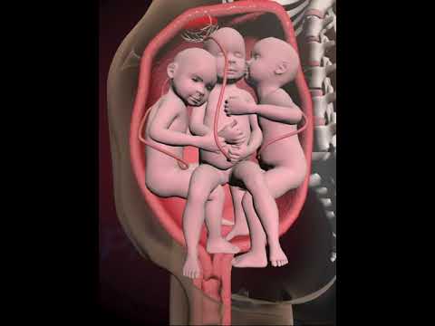 PRECIOUS MOMENTS OF TRIPLETS INSIDE THE WOMB  (3D ANIMATION)