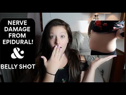 The Epidural Gave Me PERMANENT Nerve Damage| 1 Month Postpartum Update *BELLY SHOT*