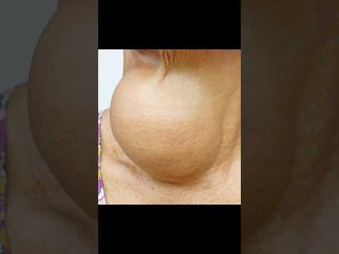 Goiter! Huge Thyroid Growth in Someone’s Neck!