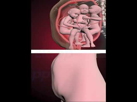 PRECIOUS MOMENTS OF TRIPLETS INSIDE THE WOMB  (3D ANIMATION)