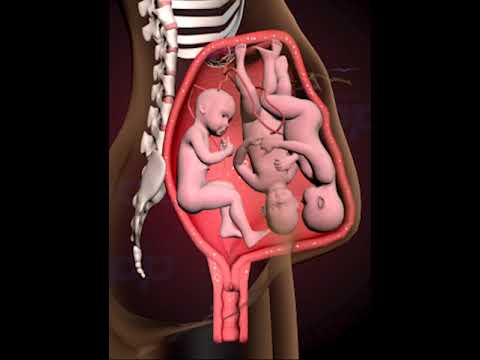 PRECIOUS MOMENTS OF TRIPLETS FIGHTING INSIDE THE WOMB  (3D ANIMATION)