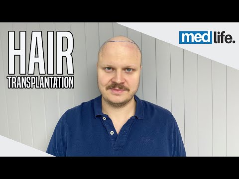 Indrek's Medical Journey in Turkey | Hair Transplant