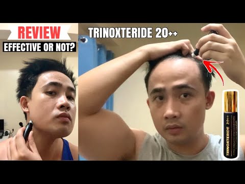 Trinoxteride 20++ Review: RESULT after using for 1 month | Effective or Not?