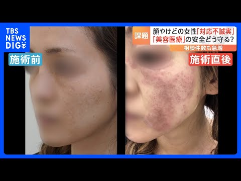 「美容医療」の安全どう守る　シミ治療でやけども　トラブルの背景に経験・知識が浅い医師による施術　厚労省が対策案示す｜TBS NEWS DIG