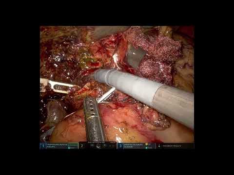 Robotic Pancreaticoduodenectomy