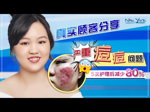 【真实顾客分享】严重痘痘问题｜5次护理后减少80%｜重拾自信｜New York Skin Solutions 肌肤专家