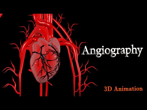 Angiography - Complete visual guide ( 3D Animation )