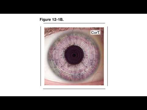 Corneal topographic astigmatism (CorT) Anterior and Total - Chapter 12