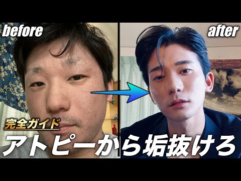 【完全ガイド】アトピー男子だった僕が垢抜けて大変身した方法