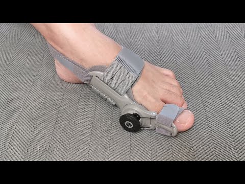 Treatmedy Bunion Fix Unboxing and Review - Does It Really Work?