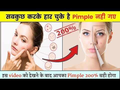 Pimple हटाने के लिए ये करे | Pimple ke liye kya karen | Pimple ko jad se khatm kaise karen#beauty