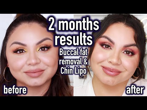 My 2 months Results - Chin Lipo and Buccal Fat Removal Surgery | Am I happy with the final result?