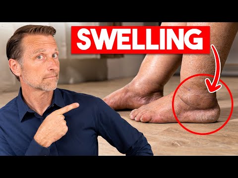 #1 Vitamin to Eliminate Swollen Legs and Ankles