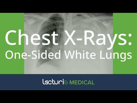 White Lung on Chest X-Ray? Learn What It Means and How to Diagnose 🩺🖤