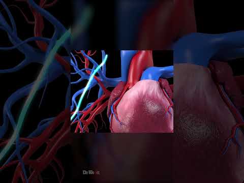 Single Heart Bypass Surgery: 3D Animation