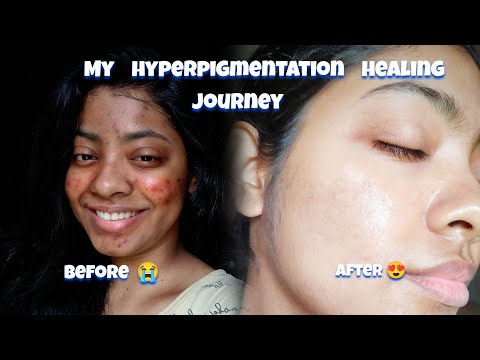 My Skintone Transformation Part 4 hyperpigmentation healing journey