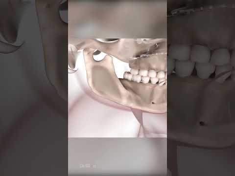 Corrective Jaw Surgery: Orthognathic Surgery