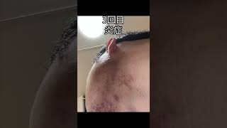 脱毛器vs脱毛サロン #shorts #脱毛