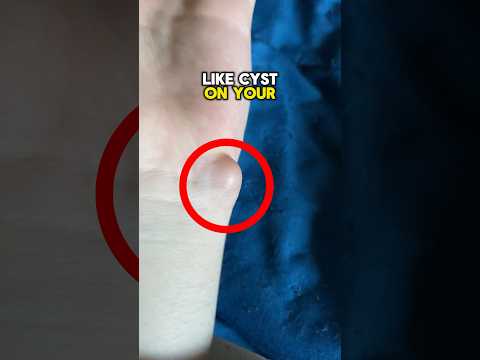 Remove This Dangerous Cyst At Home 😨 #viral