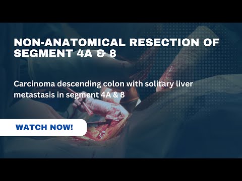 Non anatomic resection of segment 4a & 8