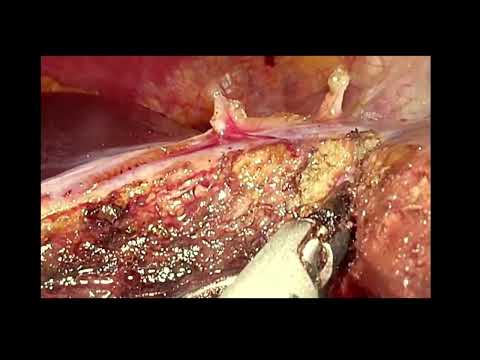 Laparoscopic left lateral sectionectomy