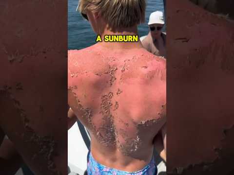 Do THIS If You Get A Sunburn 😨 #viral