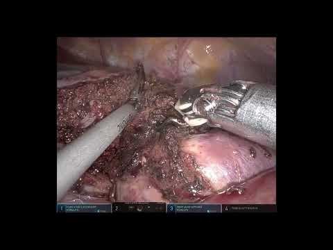 Robotic left lateral sectionectomy