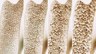 Scientists Discover New Hormone That Can Double Bone Mass