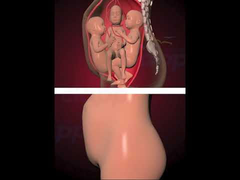 Nuchal cord - umbilical cord becomes wrapped around the fetal neck 360 degrees.(3D Animation)