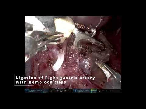 Robotic Gastrectomy 4 mins