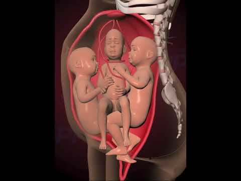 Nuchal cord - umbilical cord becomes wrapped around the fetal neck 360 degrees.(3D Animation)