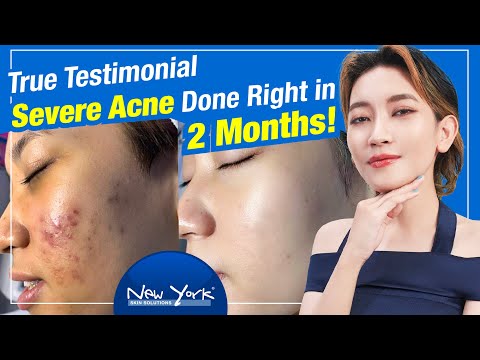 Severe Acne Done Right in 2 Months! | True Testimonial