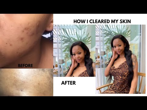 HOW I CLEARED MY ACNE USING ORATANE