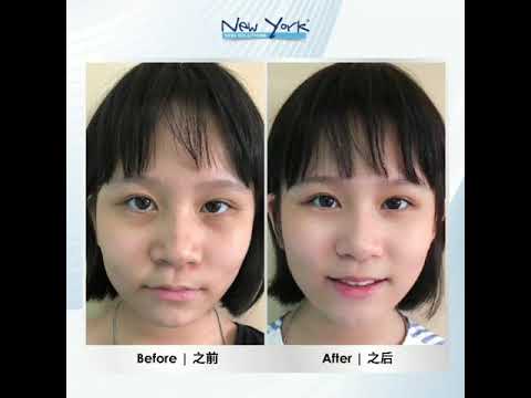 Acne during your tween | Skin problems occur at ALL ages | EFFECTIVE Acne Solution | New York Skin