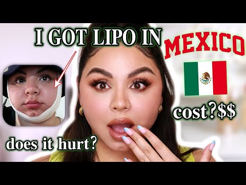 I Got Chin Lipo Surgery in Mexico My Experience Daily Updates 2 Weeks Results